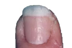 看指甲识健康,从指甲看疾病的图片说明