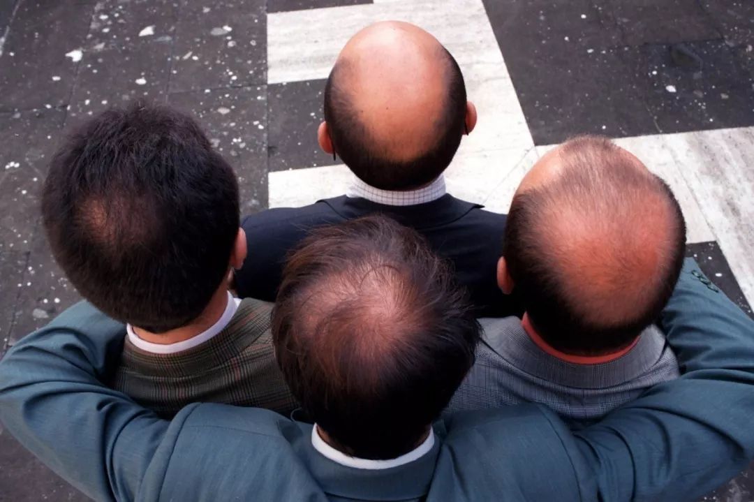 侧柏叶怎么防脱发和生发偏方大全,防脱发偏方用多久见效