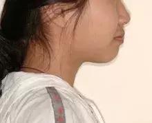 牙齿正畸堪比整容,牙齿矫正堪比整形