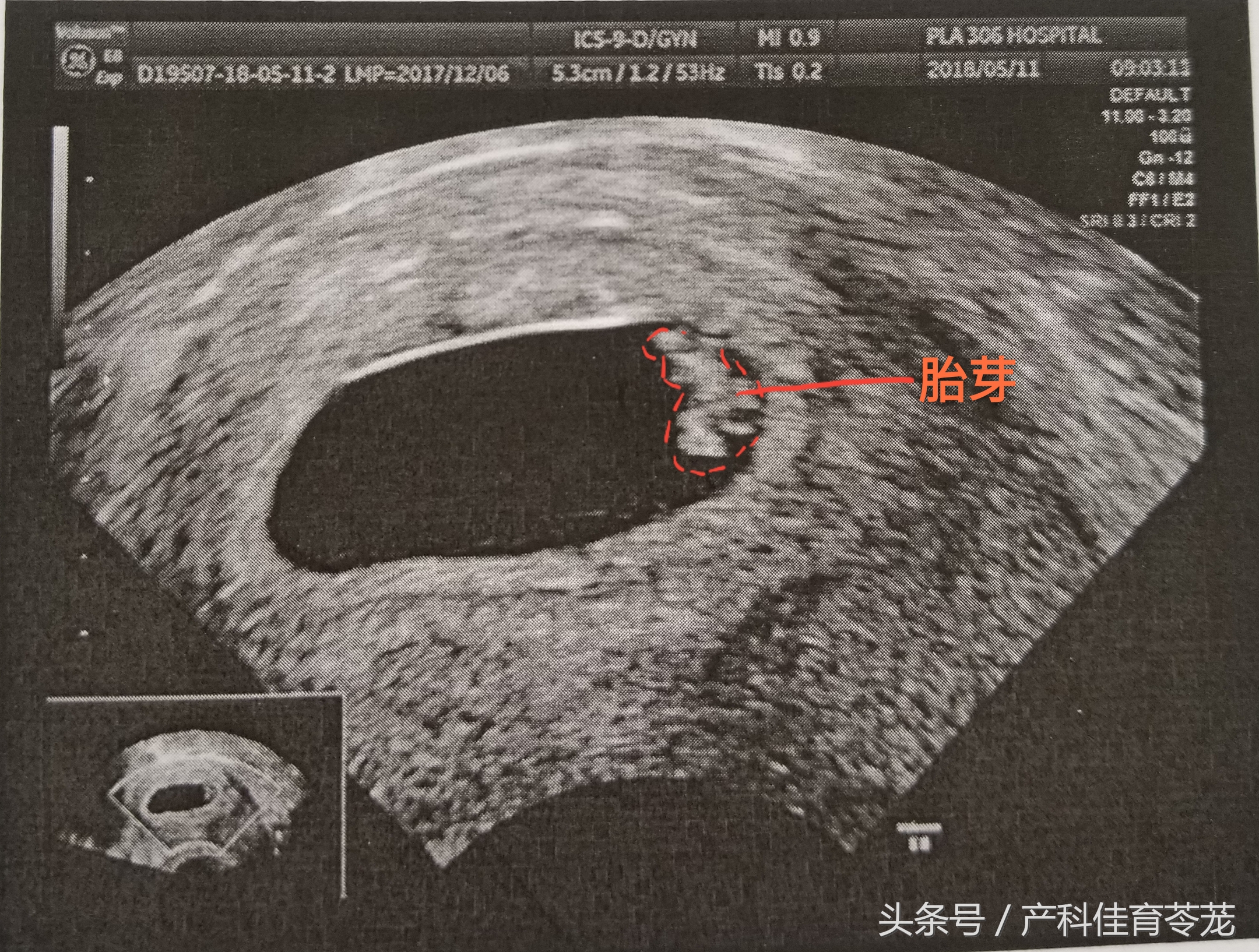 b超的3组数字代表什么,b超图片上的数字