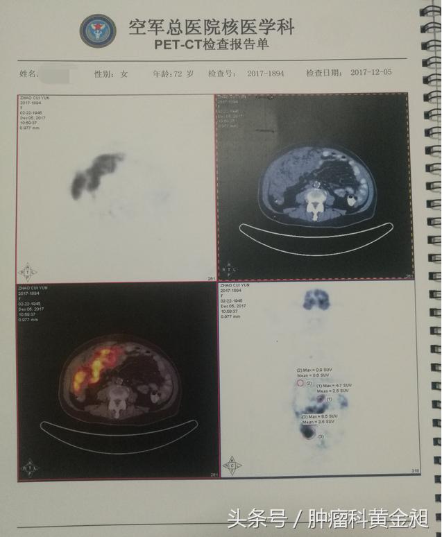病案分享:中西医结合治疗老年卵巢癌晚期至肿瘤影像学消失1例