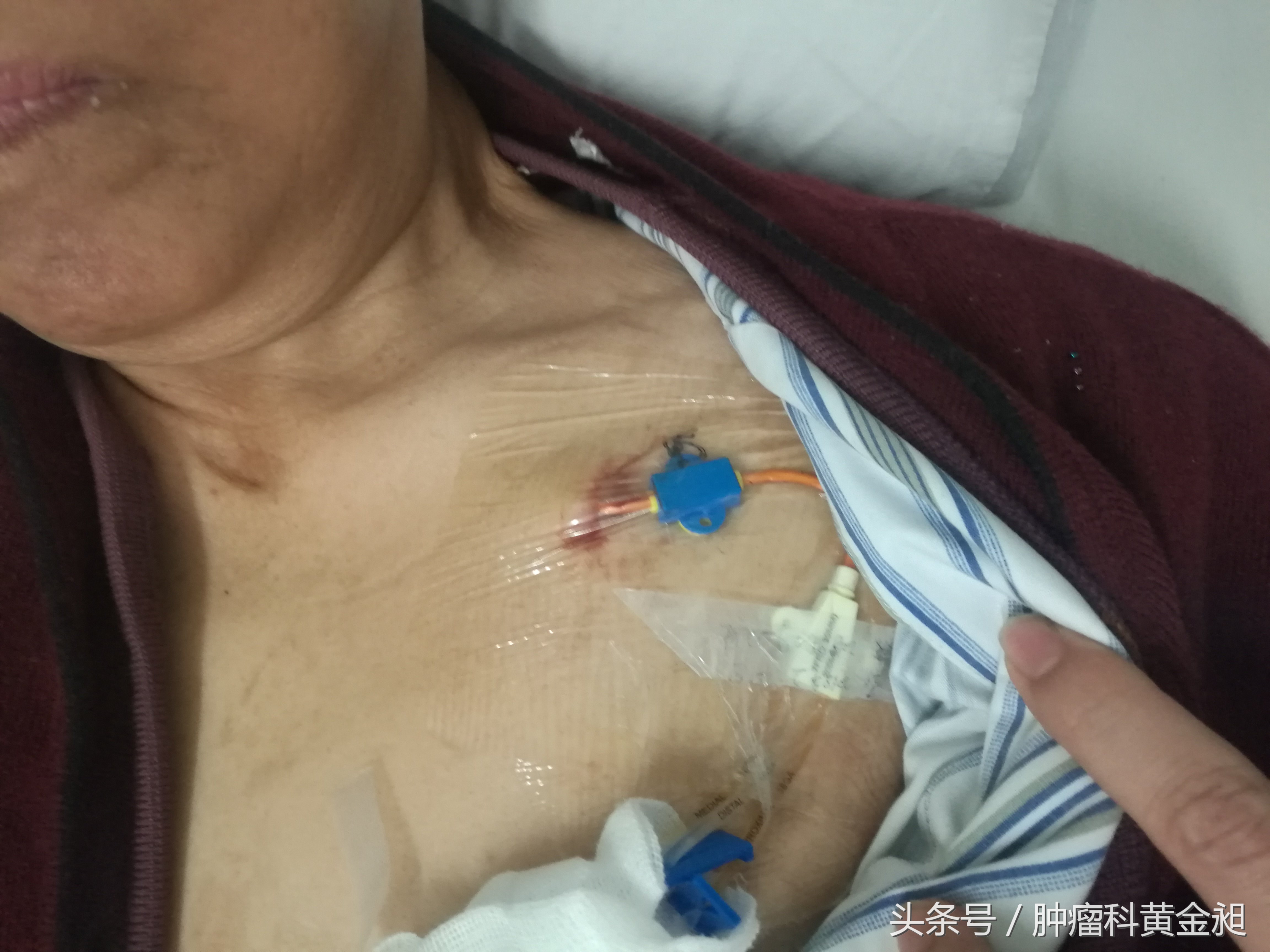 中医治疗卵巢癌晚期,卵巢癌中西医结合治疗能痊愈吗