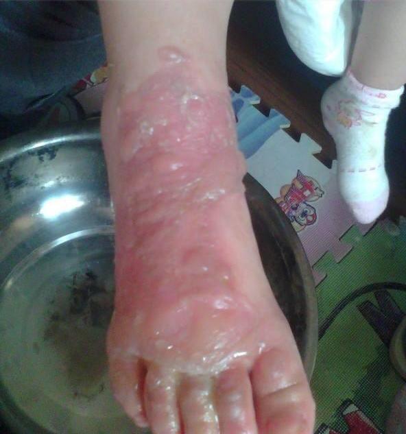 宝宝二度烫伤后期怎么好得快,宝宝二级烫伤多久可以恢复到正常