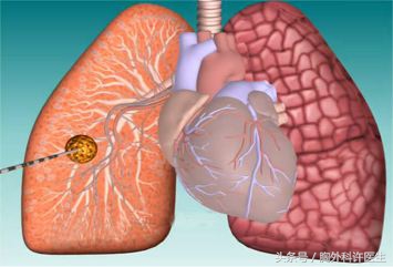 肺癌治疗仪器,肺癌手术器械