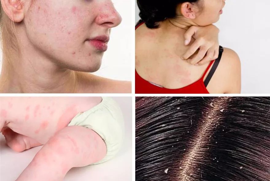 被子枕头如何除螨虫,消灭枕头上螨虫细菌的方法