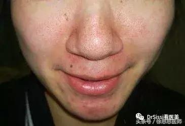 脸上80%的斑点反反复复,脸上1000多个痘坑