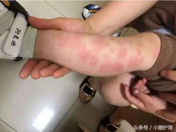 小孩皮肤红肿瘙痒是什么原因,小孩身体出现红肿并痒是怎么回事