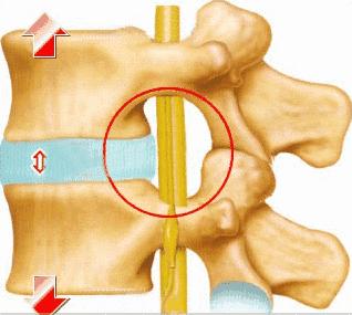 预防颈椎腰椎间盘突出的健身操,办公室预防腰椎间盘突出锻炼方法