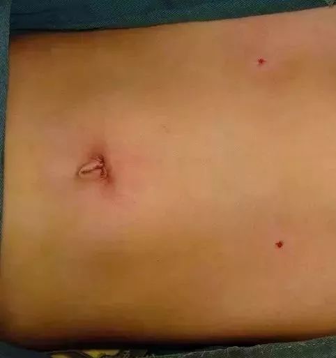 3d腹腔镜微创疝气修补术,成人疝气腹腔镜微创