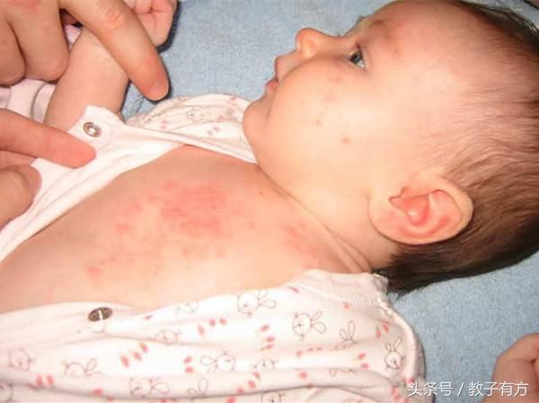 宝宝湿疹和痱子的区别和治疗方法,孩子痱子湿疹一招搞定