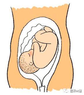 胎位不正是小孩畸形吗,胎位不正怎么顺产