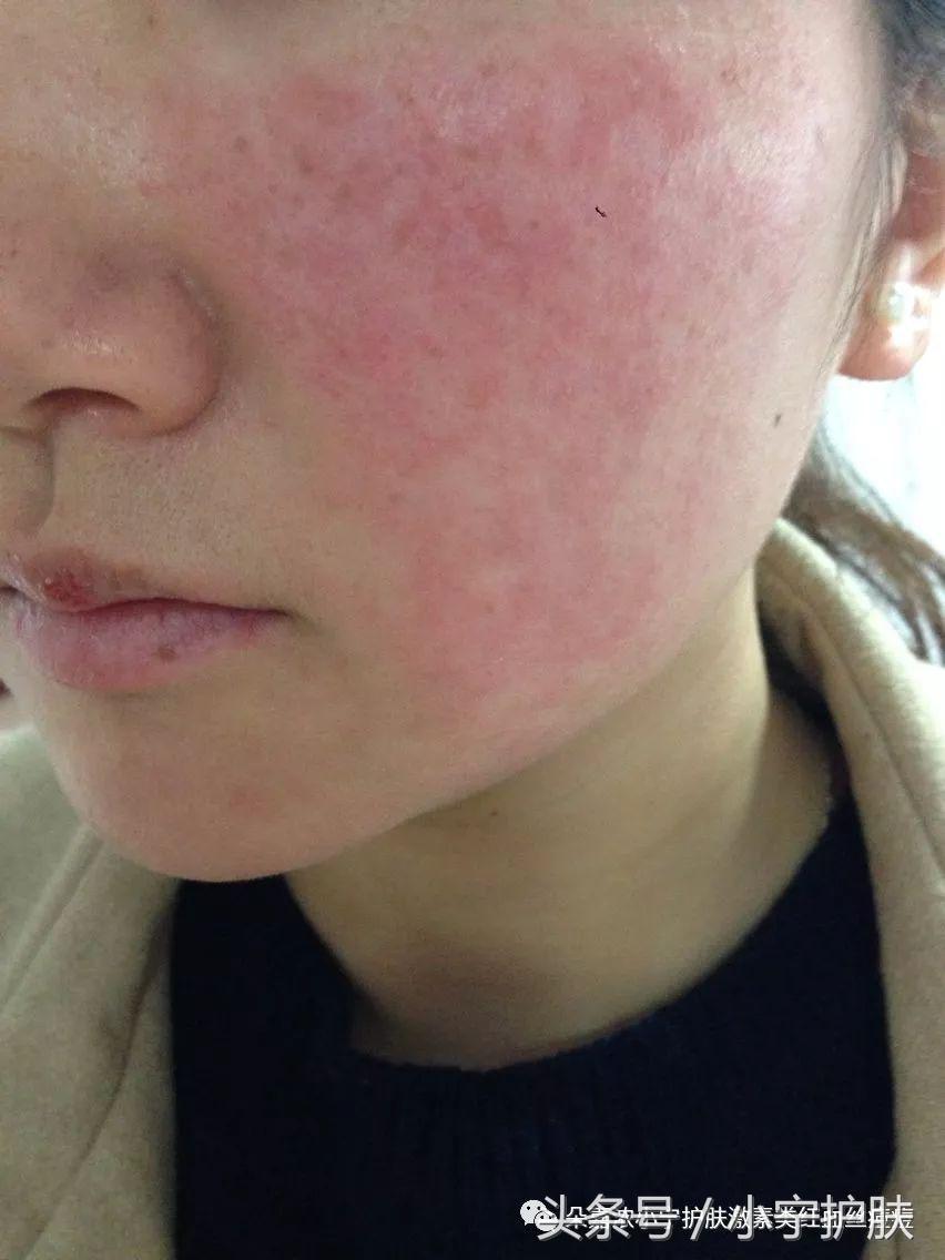 皮肤发红结痂是怎么回事,皮肤发红变皱是什么原因