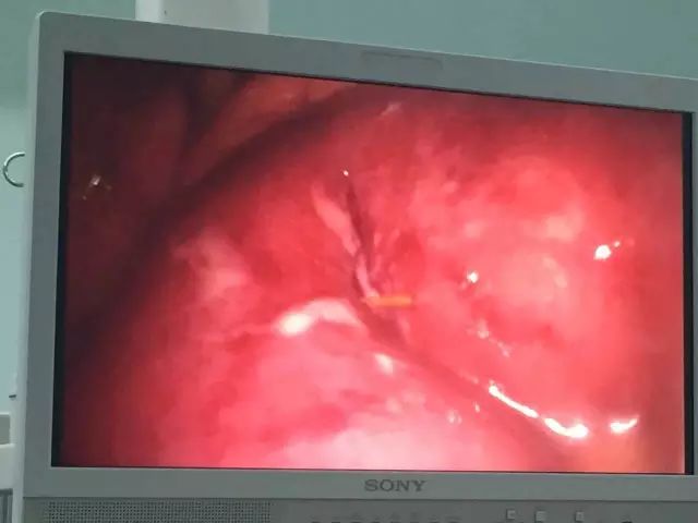 腹部烧灼样疼痛怀疑哪些疾病,腹部疼痛如何排除阑尾炎