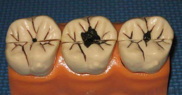 儿童牙齿上有黑色的污垢怎么去除,牙齿上有黑色的污垢用什么牙膏