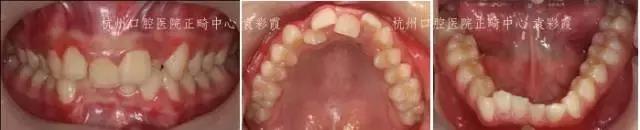 原来，上牙盖住下牙太多，也对牙齿有伤害！该怎么矫正？