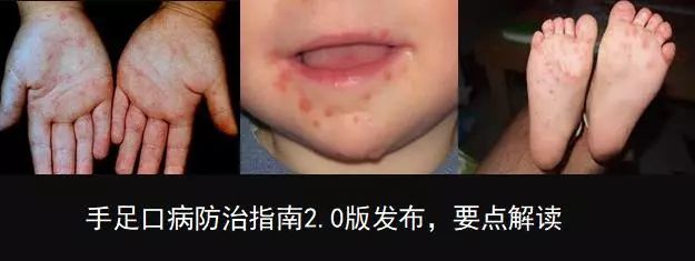 《手足口病诊疗指南2018版》发布，快来划重点