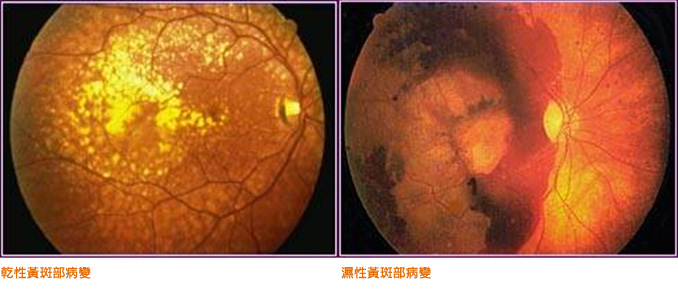 黄斑病变引起眩光怎么治疗,老人眼黄斑病变的治疗方法