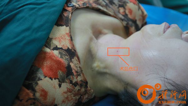 娄底市中心医院开展全市首例甲状腺结节激光消融术