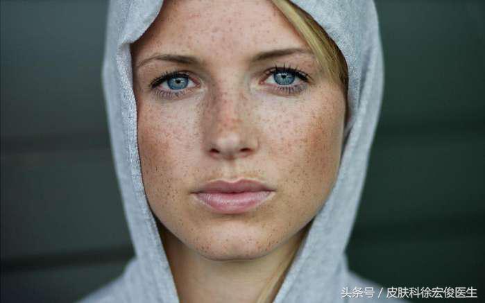 雀斑能靠药物祛除吗,雀斑靠吃药抹药调理就可以消除吗