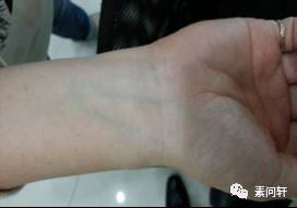 像蚯蚓一样的凸起的纹,像蚯蚓一样黑色的是什么