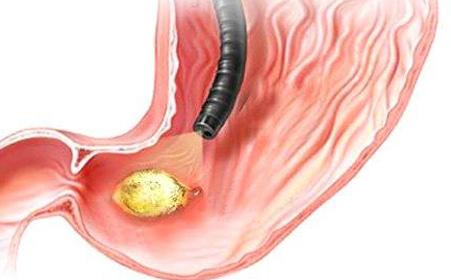 新生儿吞了母血会怎么样,新生儿为什么会吞下母血