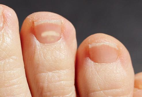 趾甲变黄怎么处理,指甲变白什么原因