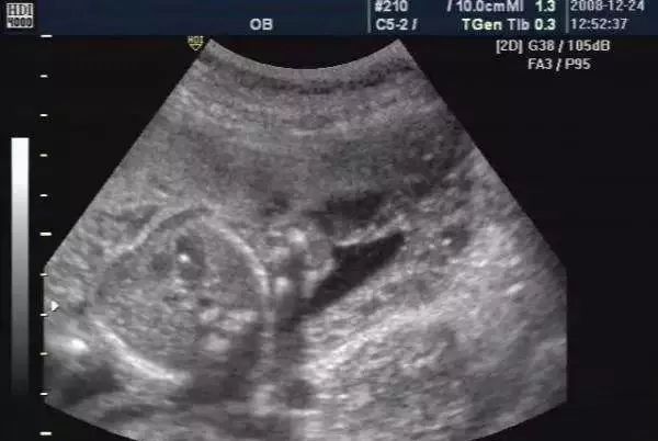 产检心室有强光斑,心室强光斑是怎么回事