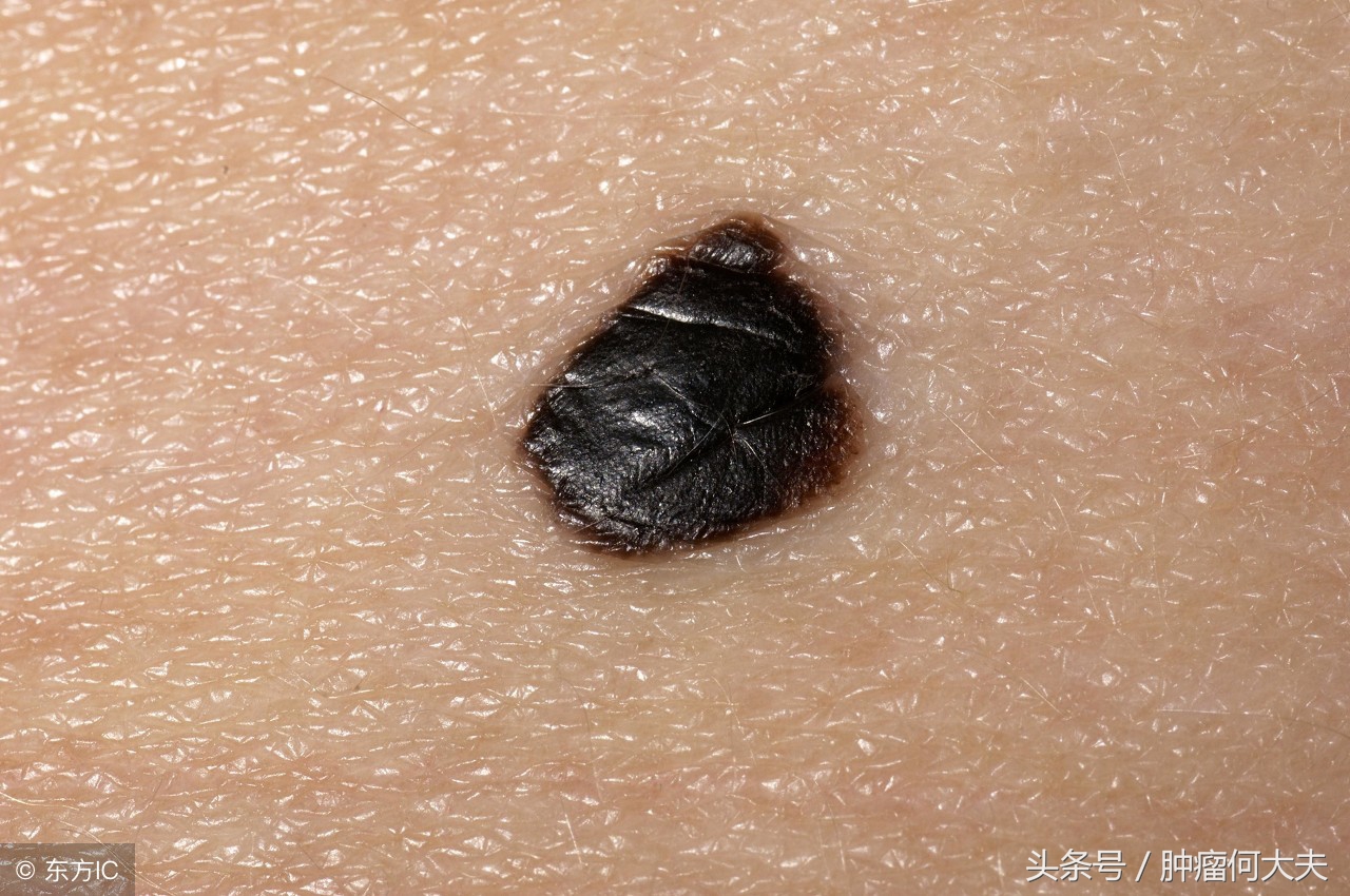 皮肤上长黑色素痣恶性图片,正常的黑痣和黑色素瘤有什么区别