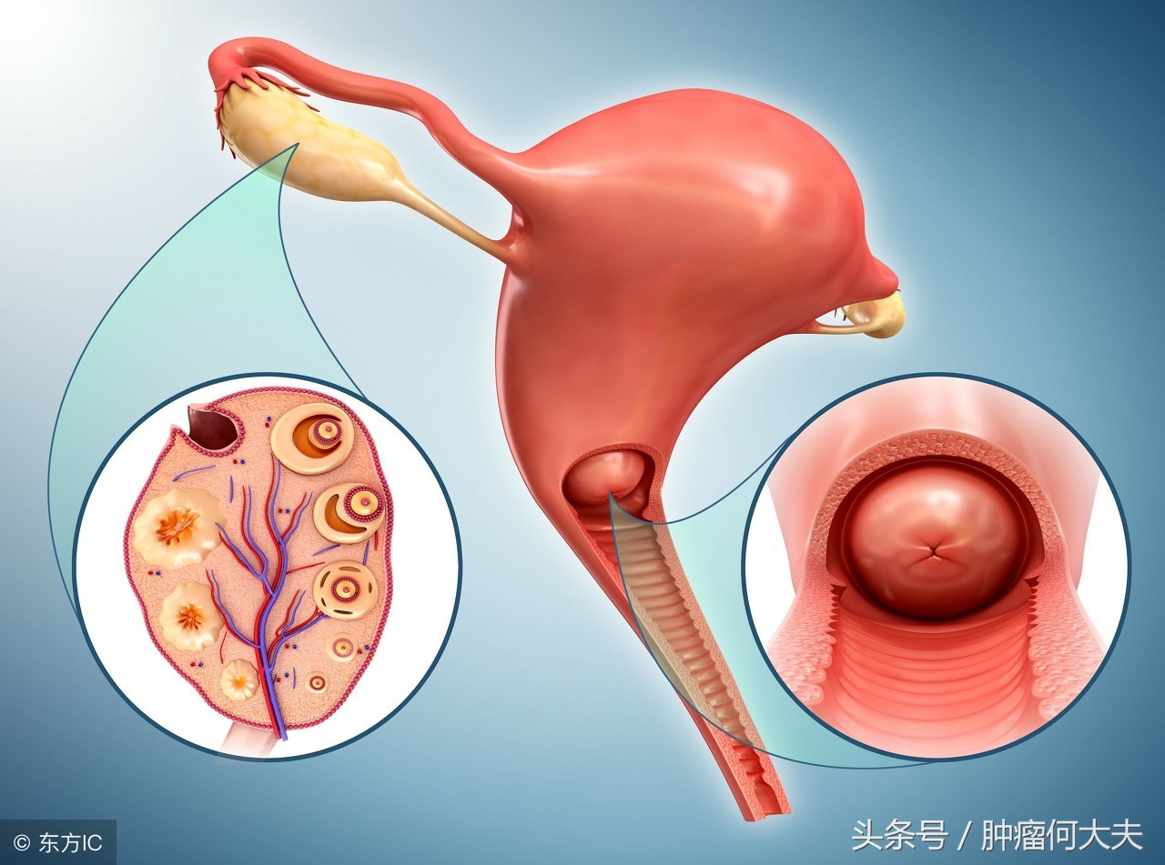 宫颈癌的症状什么人容易得宫颈癌,为什么会得宫颈癌有什么症状表现