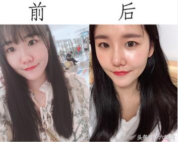 隆鼻后如何克服焦虑,隆鼻后前三天状态