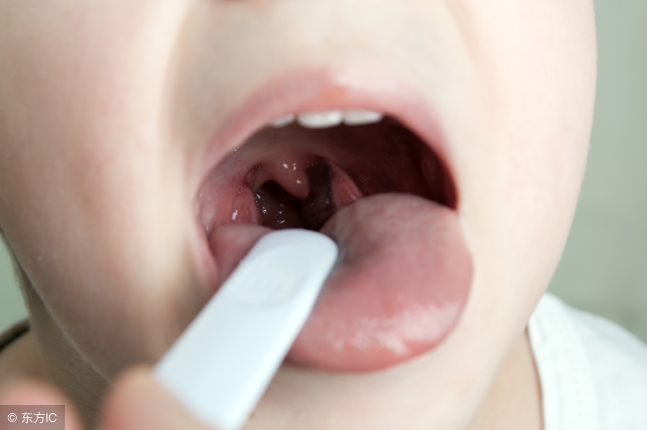 如何预防和治疗疱疹性咽峡炎,怎样预防和治疗疱疹性咽峡炎