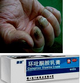 皮肤真菌感染诊断结果,皮肤真菌感染治疗方法