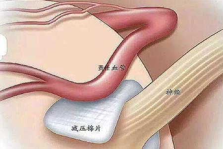 引起面部三叉神经疼的原因,三叉神经痛显微减压手术危险吗