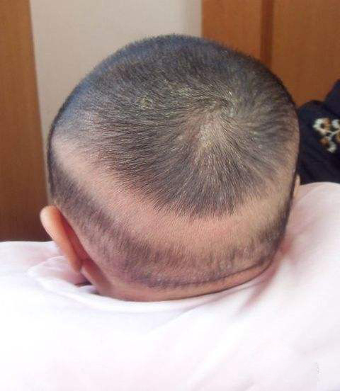 小孩头发秃了一圈,宝宝头后面头发秃了一圈