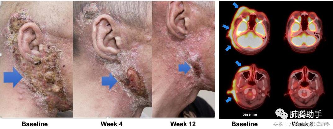 第四代抗癌新药,抗癌新药拉罗替尼