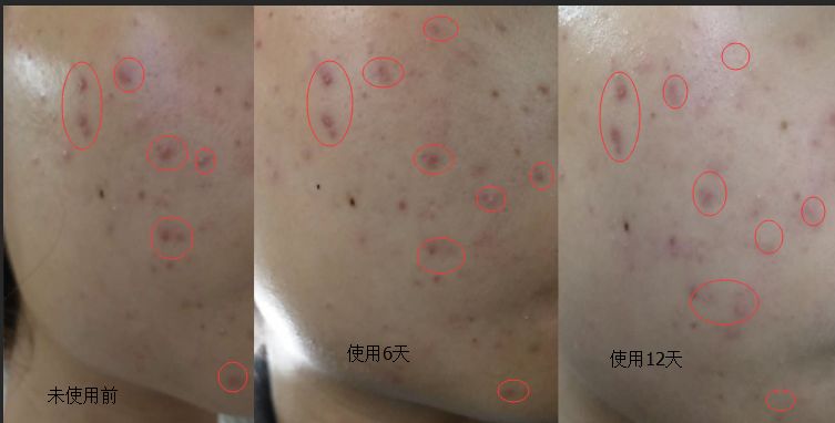 作为一个长痘痘多年的人,分享给痘友抗痘经历