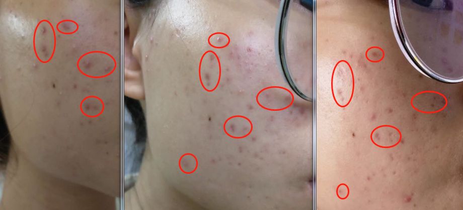 作为一个长痘痘多年的人,分享给痘友抗痘经历