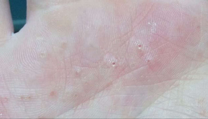 手脚起小水泡很痒怎么根治,手脚长小水泡奇痒怎么治疗