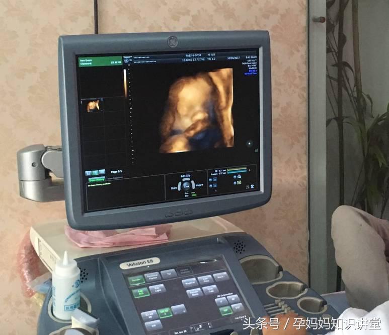 大排畸四维彩超宝宝不配合怎么办,四维彩超大排畸怎么样才算正常
