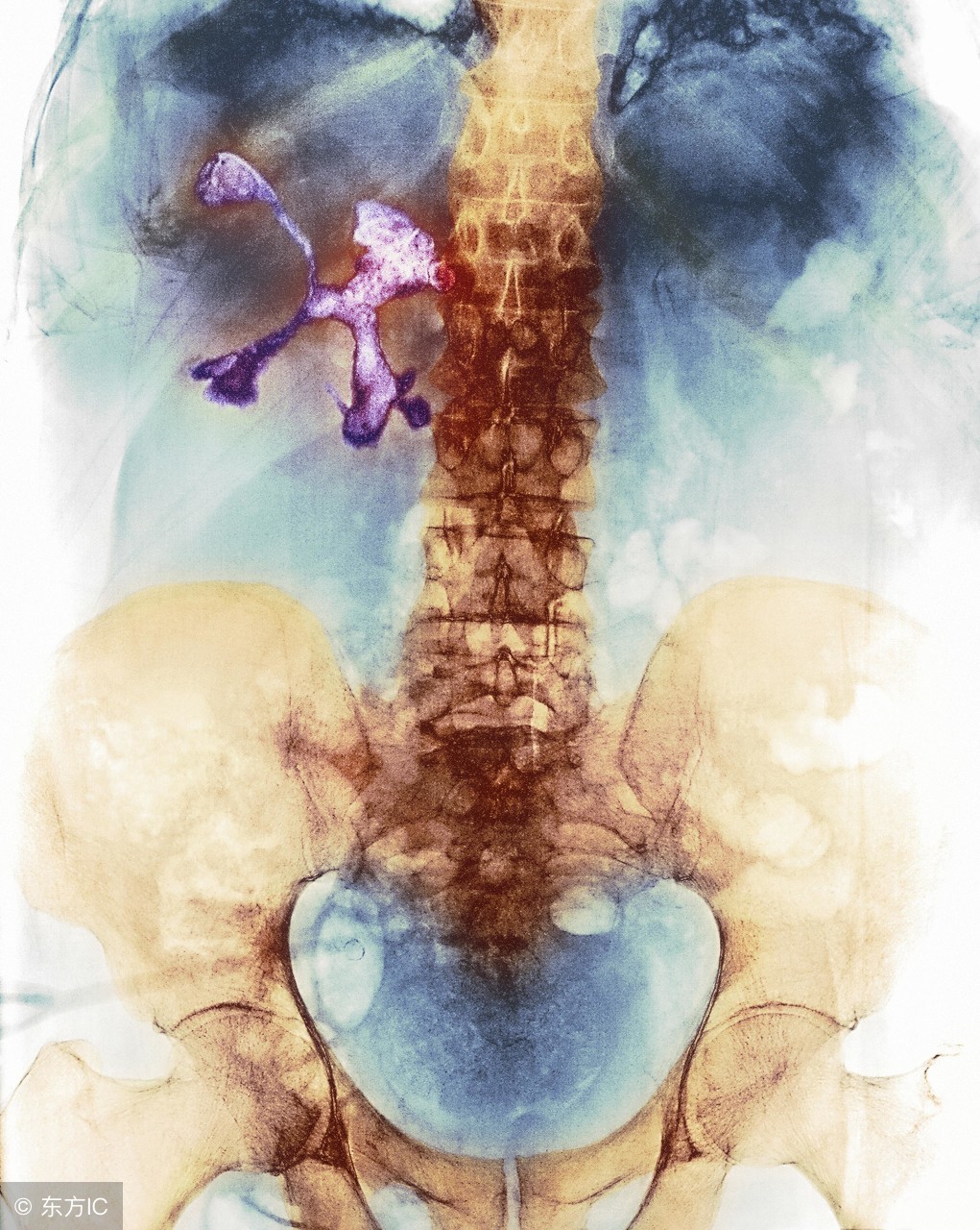 尿道结石微创术,尿道结石的微创手术全过程