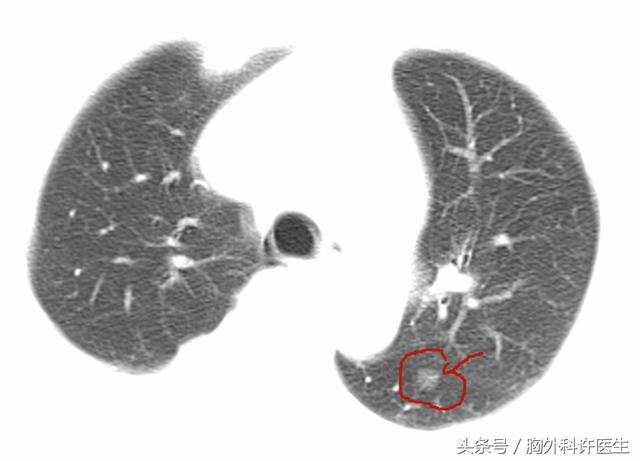 肺部GGO（磨玻璃结节）有误诊的可能性吗？