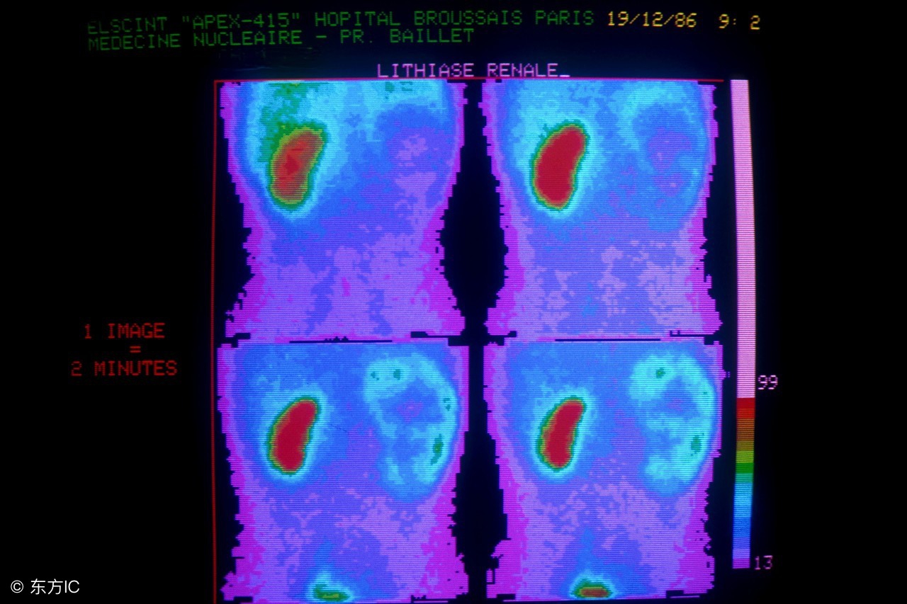 尿道结石引起血尿有哪些症状,尿结石患者尿痛是怎么回事