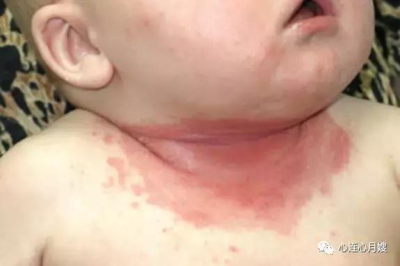 炉甘石有副作用怎么修复,炉甘石和什么止痒效果最好