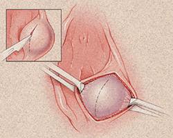 关于前庭大腺囊肿的成因,关于前庭大腺囊肿的正确描述