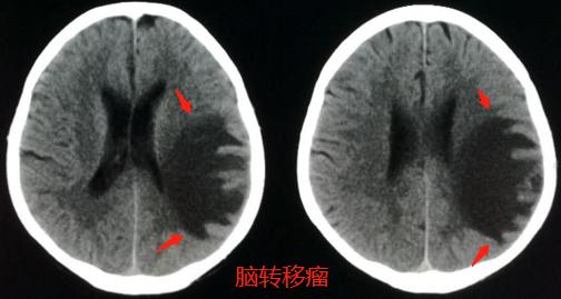 肺癌脑部转移还有脑血栓,脑梗查出肺结节怀疑肺癌