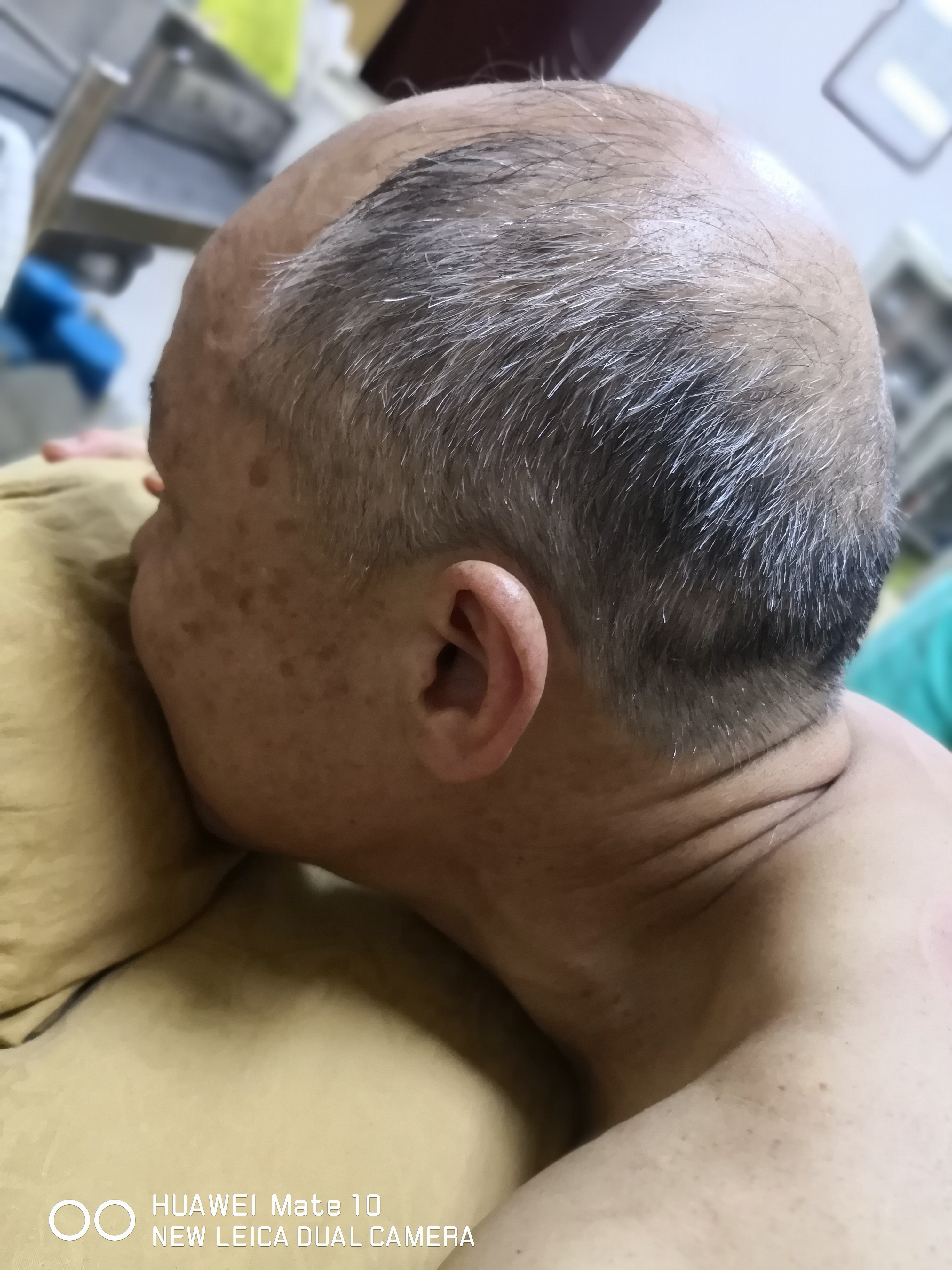 股骨头坏死二期置换好吗,遗传型脱发白发