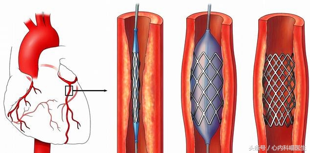心绞痛需要放入支架吗,心绞痛要不要放支架