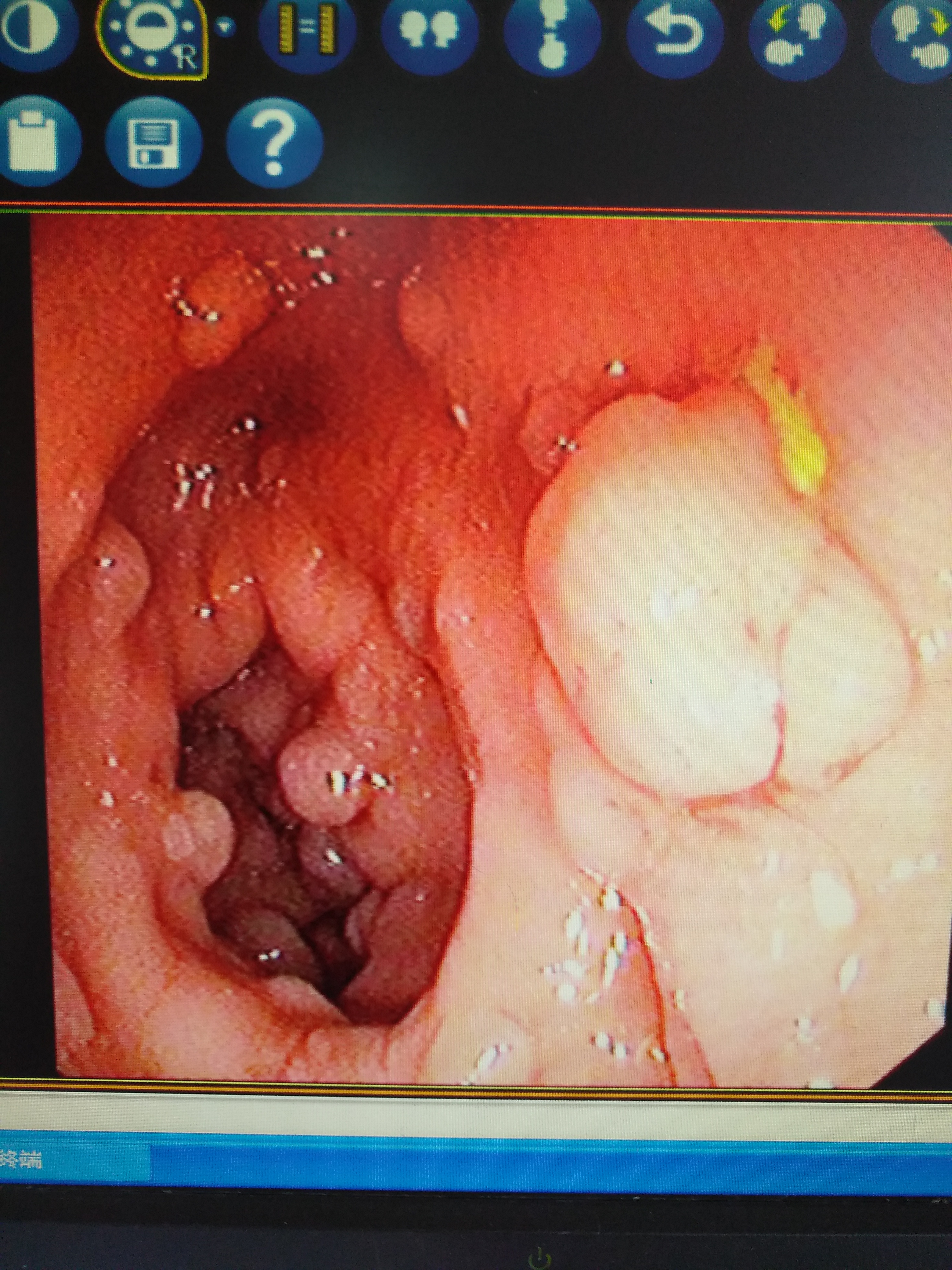 嘴唇上出现黑斑与肠胃疾病,下嘴唇上有黑斑就是胃有问题吗