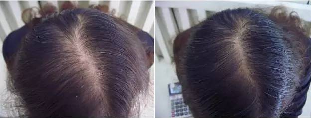 脱发、发际线高、地中海的克星！用它，1个月头发不掉了，不痒了，半年变浓密