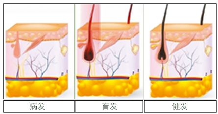 脱发、发际线高、地中海的克星！用它，1个月头发不掉了，不痒了，半年变浓密